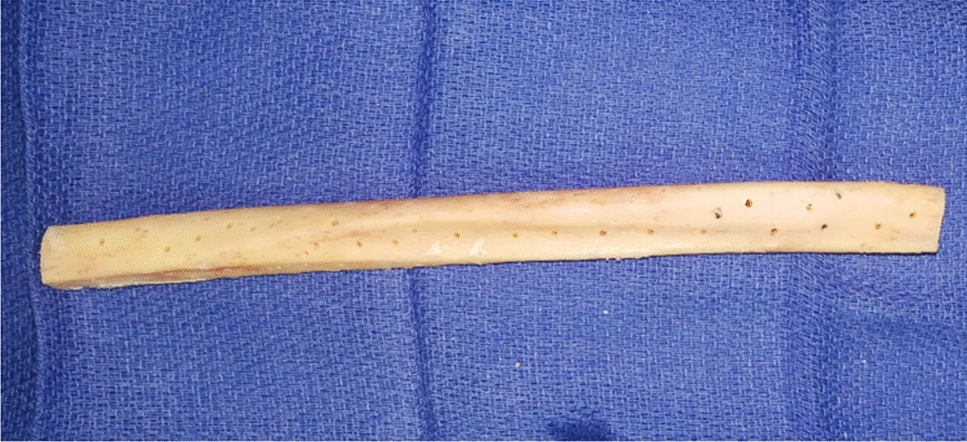 Masquelet technique including a multiperforated non-vascularized fibula graft for the reconstruction of massive post-traumatic bone defects in military practice
