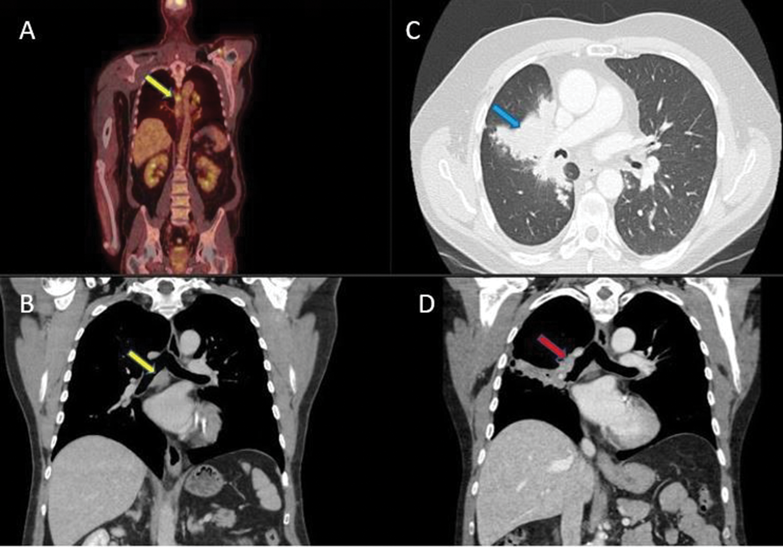 The radiologic spectrum of neuroendocrine tumors in emergent care