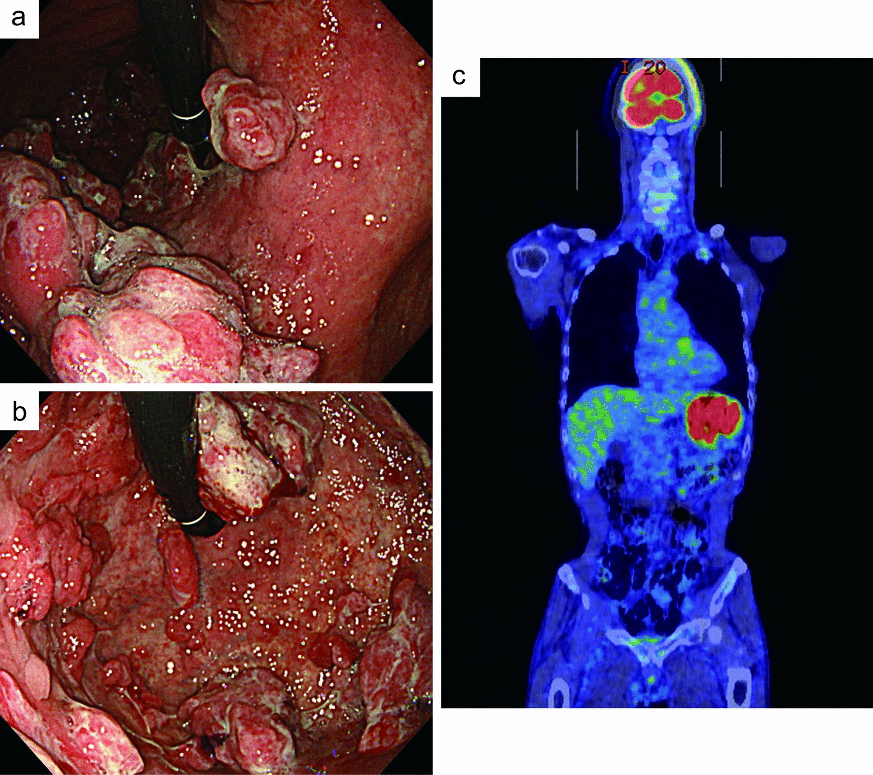 Coexistence of plasmablastic lymphoma and adenocarcinoma in the stomach: a case report and literature review