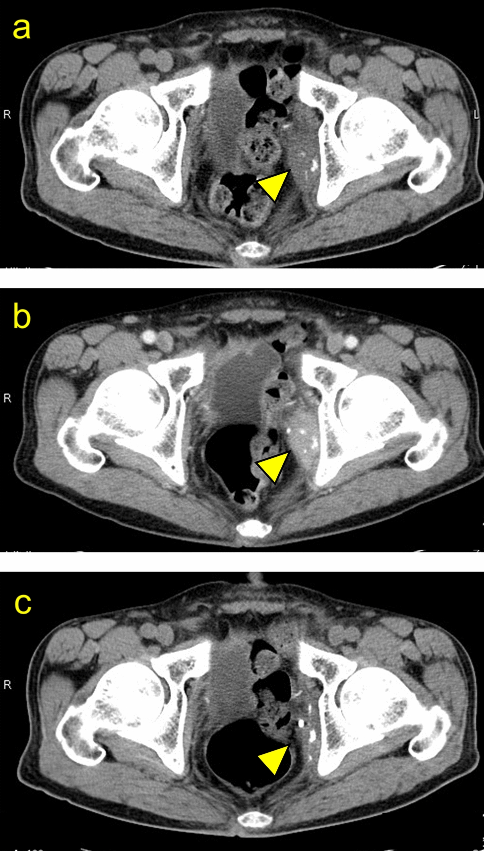 A case of remarkable response to combined radiation therapy, enfortumab vedotin, and pembrolizumab in metastatic urothelial carcinoma