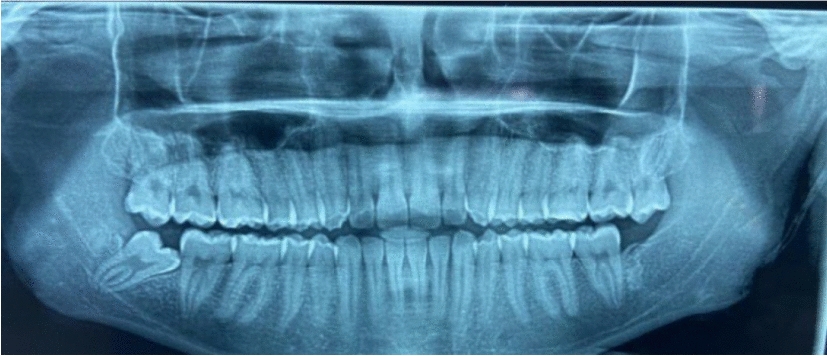 A Comparative Evaluation of Single-Suture Versus Conventional Three-Suture Technique for Closure After Surgical Removal of Impacted Mandibular Third Molar: A Randomized Controlled Trial