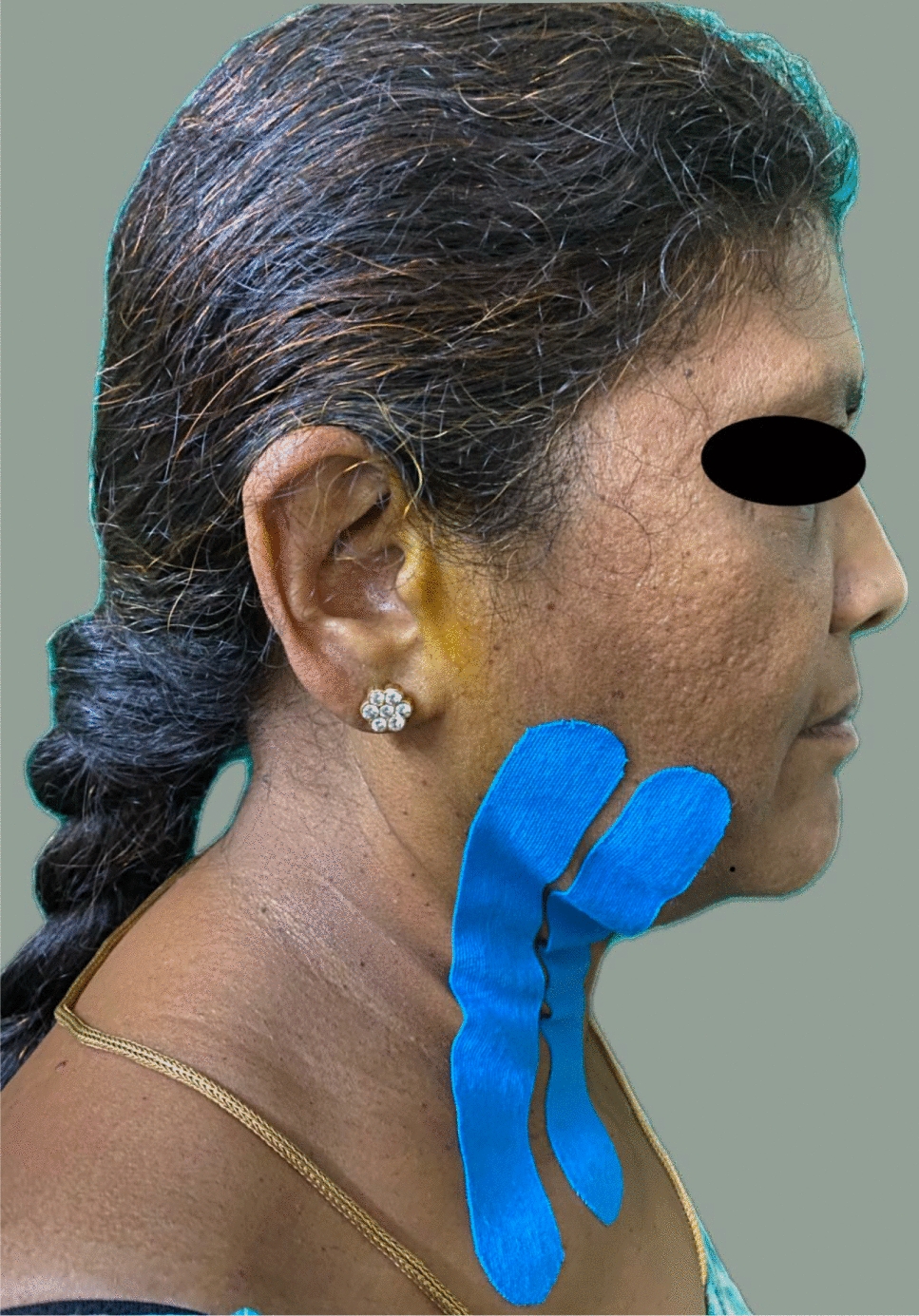 The Effect of Kinesio Taping After Impacted Third Molar Surgery: A Randomized Control Trial
