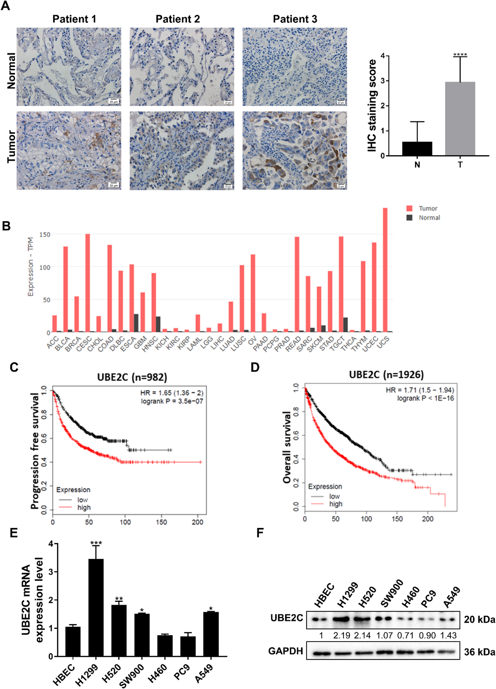 UBE2C regulating the lung carcinoma progression via inhibiting ubiquitin-proteasomal degradation to increase MMP9 protein stability