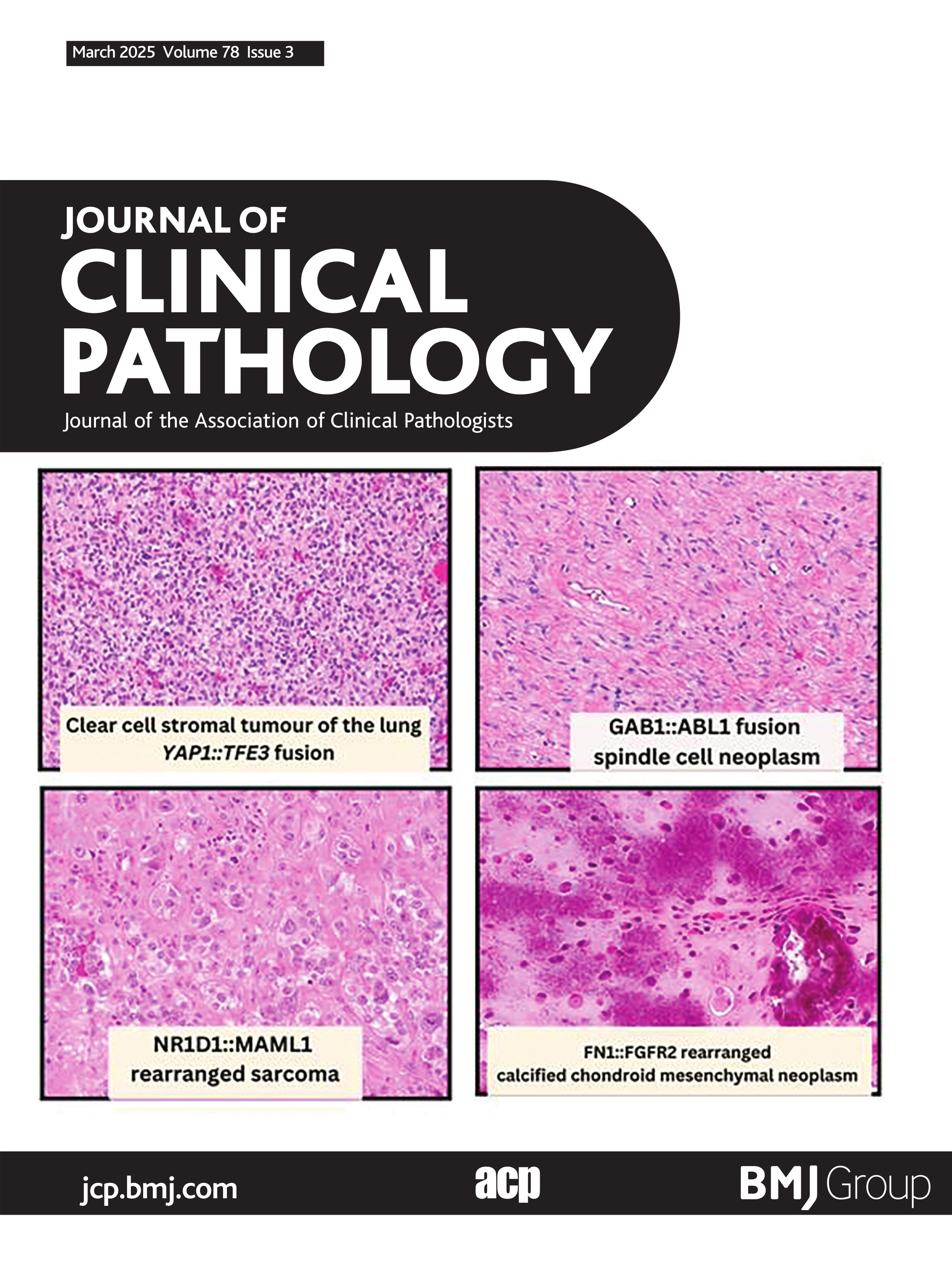 Peripheral blood smear and bone marrow findings in spontaneous tumour lysis syndrome associated with haematolymphoid malignancies