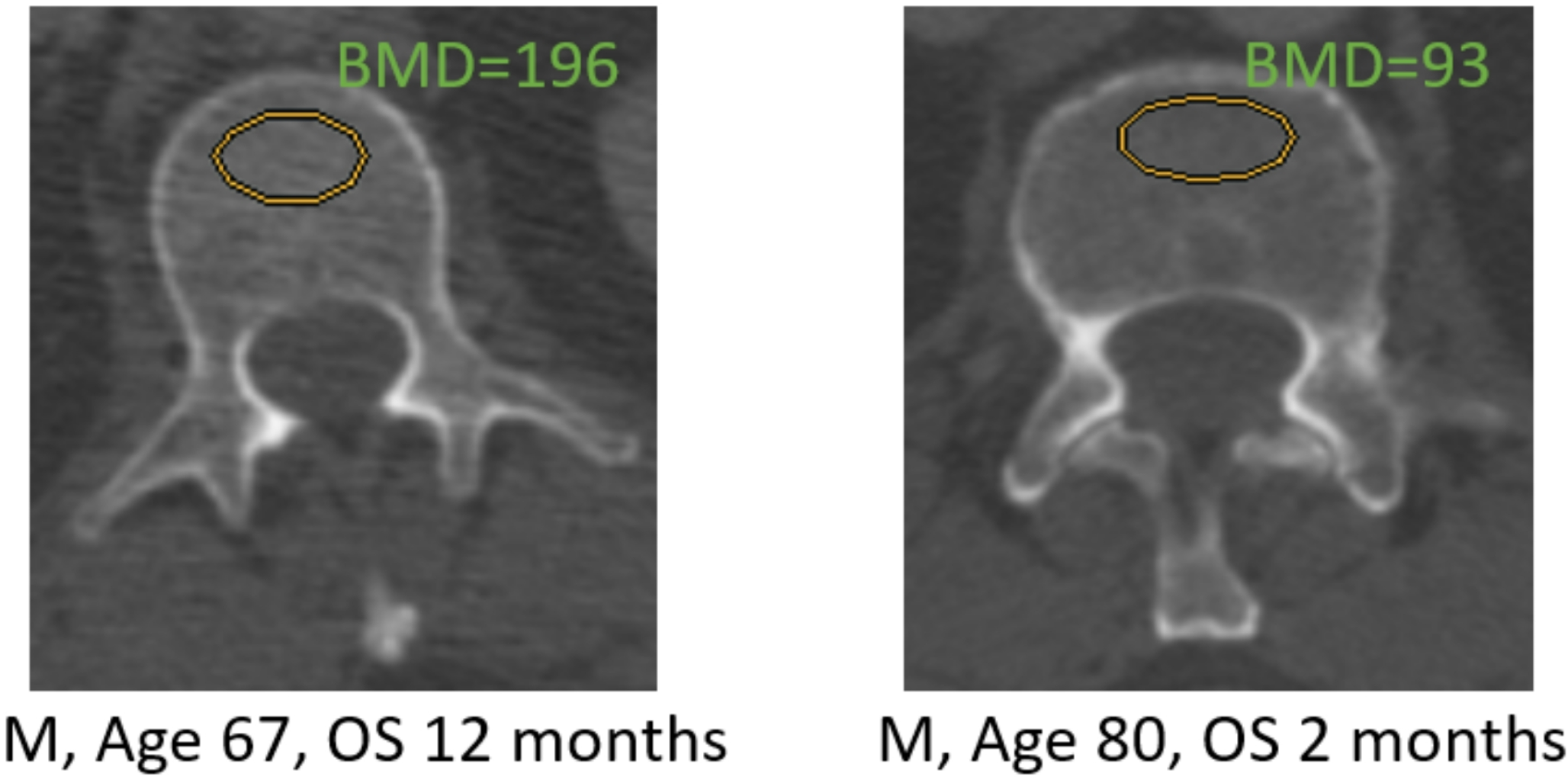 Bone mineral density as potential individual prognostic biomarker in patients with neurosurgically treated spinal metastasis