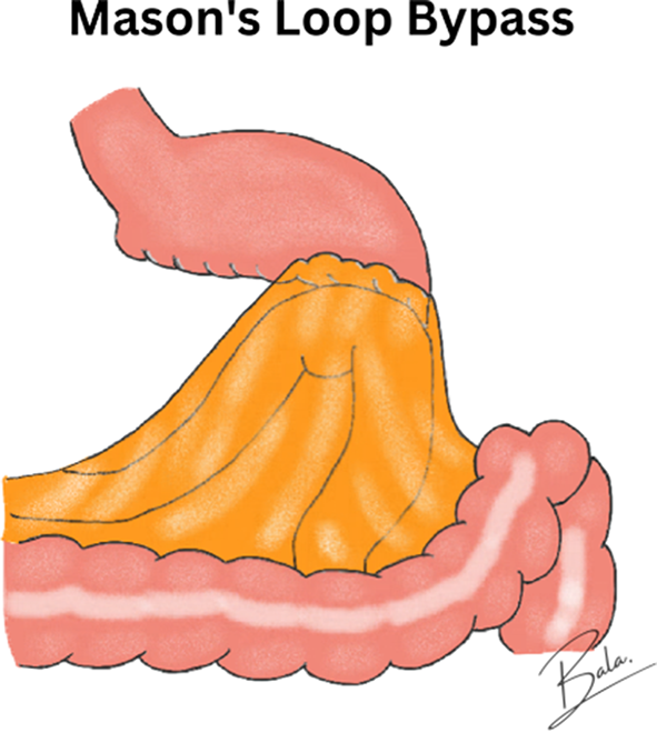 Optimal Bilio-Pancreatic Limb (BPL) Length in One Anastomosis Gastric Bypass (OAGB) Surgery
