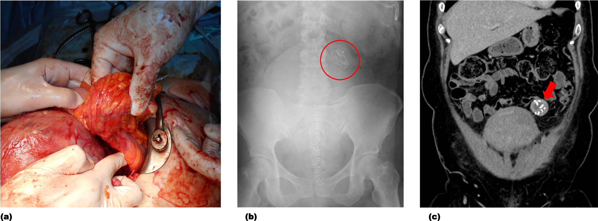 Efforts to prevent surgical sponge retention: check X-ray on the big screen