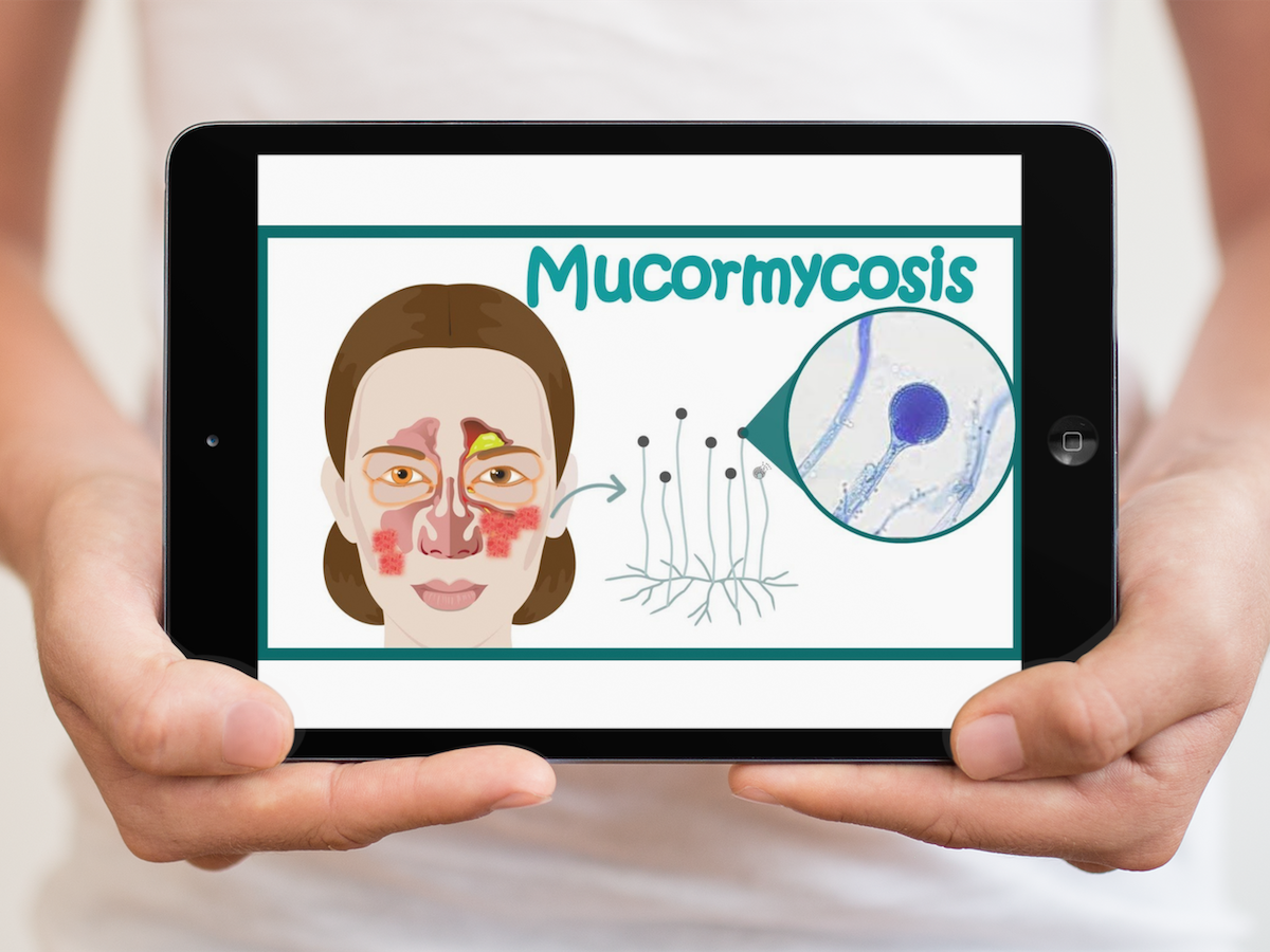 Comparative Evaluation of Effectiveness of Standard of Care Alone and in Combination With Homoeopathic Treatment in COVID-19–Related Rhino-Orbito-Cerebral Mucormycosis (ROCM): Protocol for a Single Blind, Randomized Controlled Trial