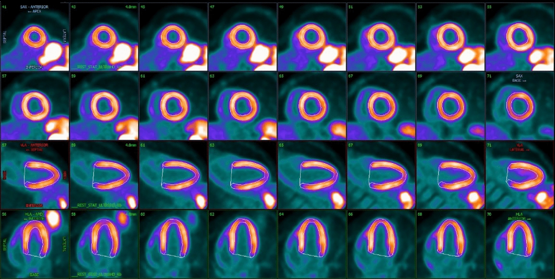 Advances in Imaging Techniques for Assessing Myocardial Microcirculation in People with Diabetes