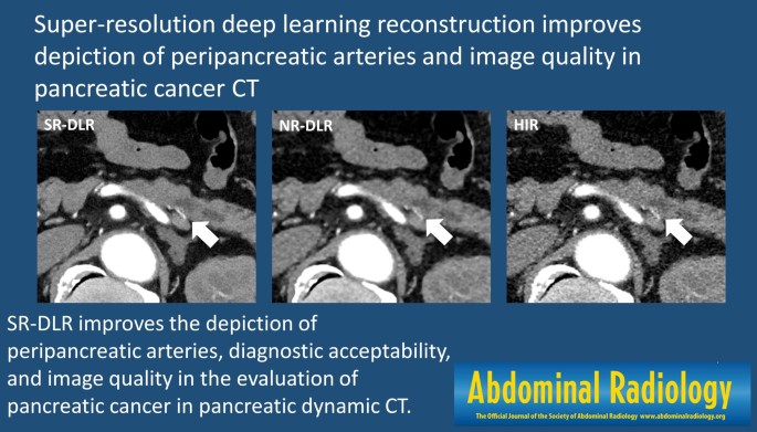 Super-resolution deep learning reconstruction improves the depiction of peripancreatic arteries and image quality in pancreatic cancer CT