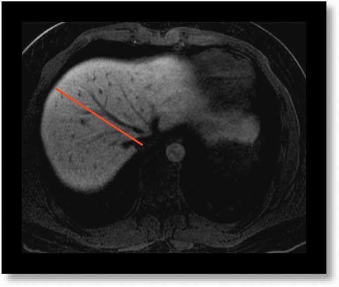 Liver regeneration after living donor liver transplantation (LDLT)