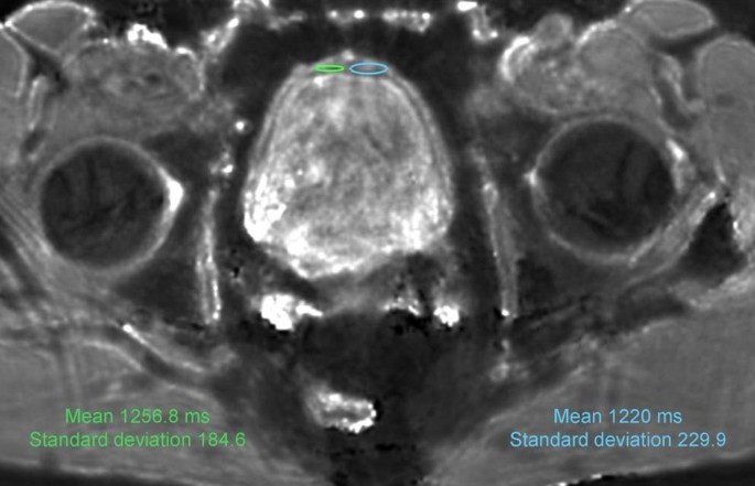 Magnetic resonance fingerprinting of the bladder is feasible in men with lower urinary tract symptoms