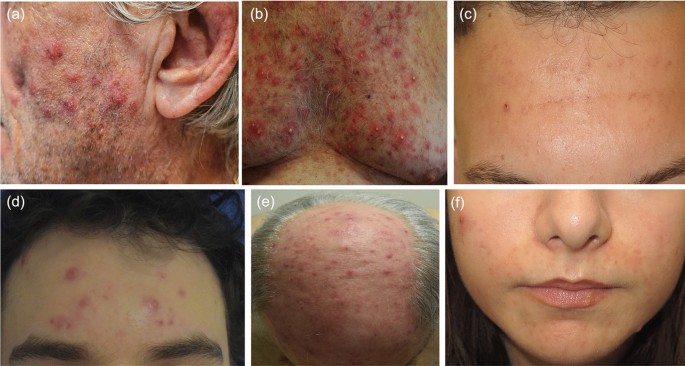 Dermatologic Toxicities Induced by JAK Inhibitors