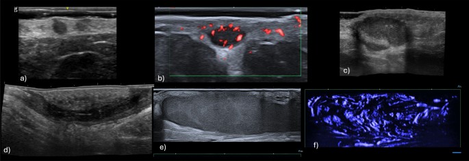 High-Frequency Ultrasound in Hidradenitis Suppurativa: From Lesion Detection to Iconographic Lesion-Level Management