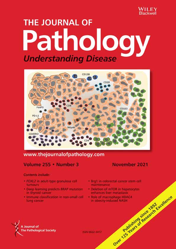 P2X4 purinergic receptors offer a therapeutic target for aggressive prostate cancer