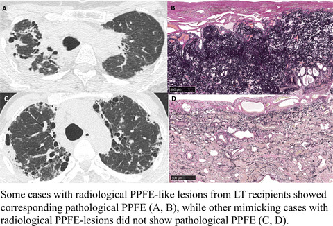 Clinical, radiological, and pathological features of idiopathic and secondary interstitial pneumonia cases with pleuroparenchymal fibroelastosis undergoing lung transplantation