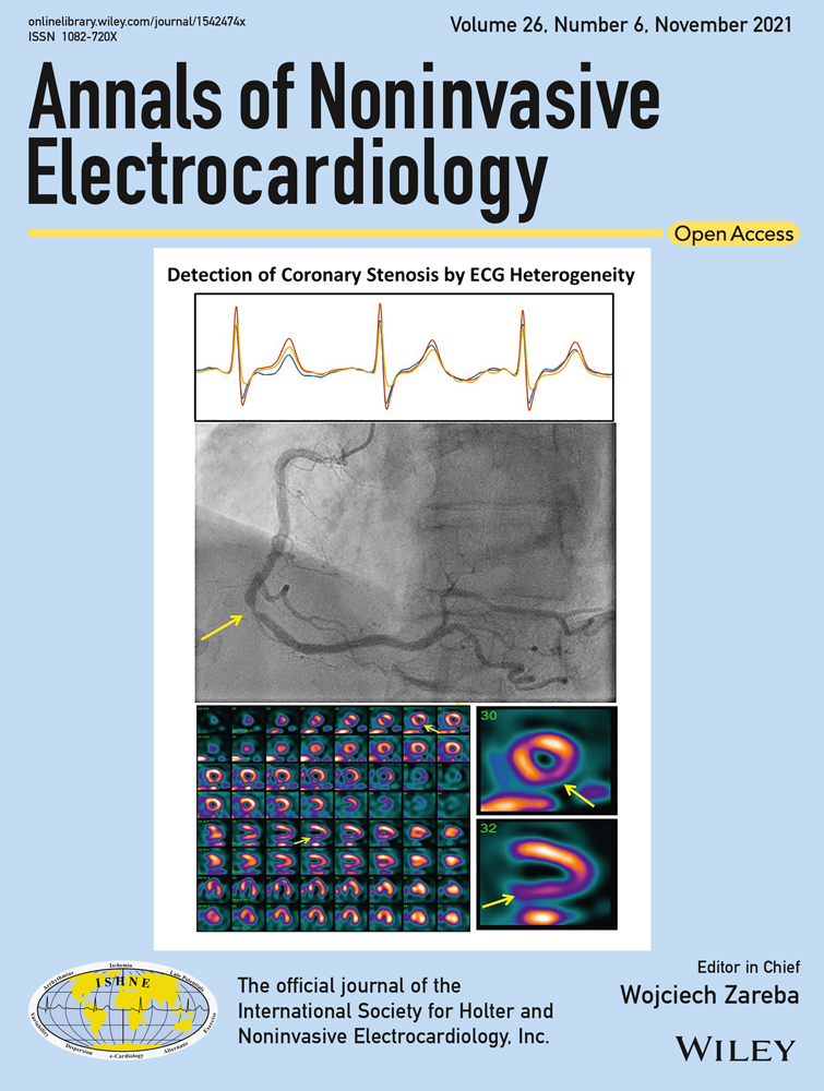 Atypical de Winter ECG pattern may be the mirror image of ST elevation
