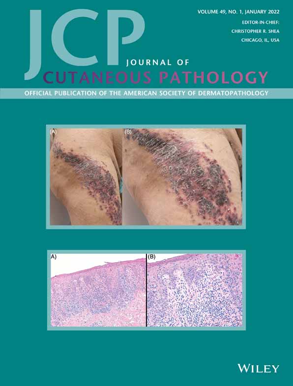 Identifying histopathologic features of erythema elevatum diutinum and granuloma faciale