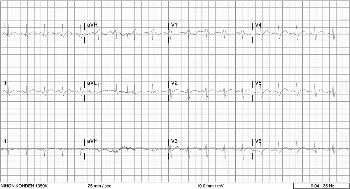 Successful clozapine rechallenge after myopericarditis: a case report