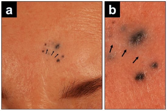 Dermatopathology, Vol. 9, Pages 361-367: Recurrence of a Cellular Blue Nevus with Satellitosis&mdash;A Diagnostic Pitfall with Clinical Consequences