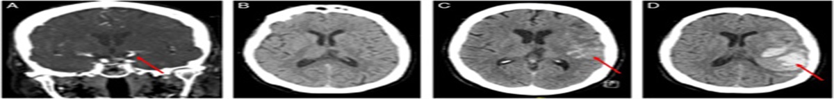 Periprocedure Management of Blood Pressure After Acute Ischemic Stroke