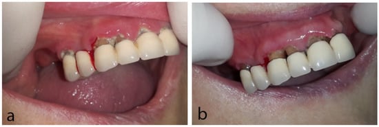 Dentistry Journal, Vol. 10, Pages 232: Oral Side Effects in Patients with Metastatic Renal Cell Carcinoma Receiving the Antiangiogenic Agent Pazopanib&mdash;Report of Three Cases