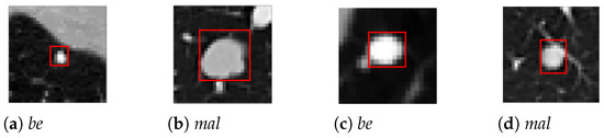 Applied Sciences, Vol. 13, Pages 377: Multi-Granularity Dilated Transformer for Lung Nodule Classification via Local Focus Scheme