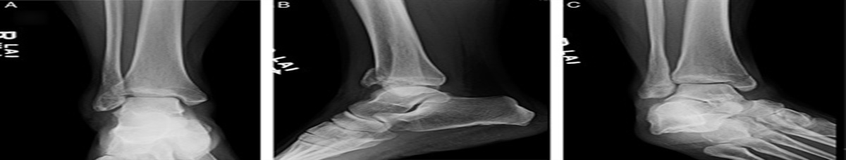 Patient-reported Outcomes of Revision Ankle Open Reduction Internal Fixation