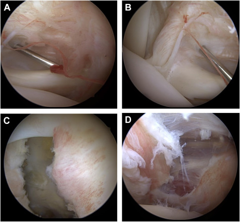 Adhesive Capsulitis