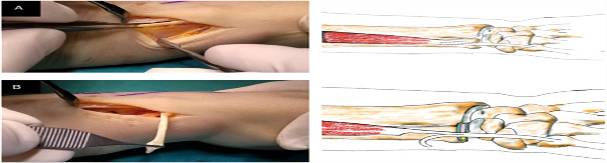 Extensor Carpi Ulnaris “Turn Around” Ligamentoplasty For Distal Radioulnar Joint Instability