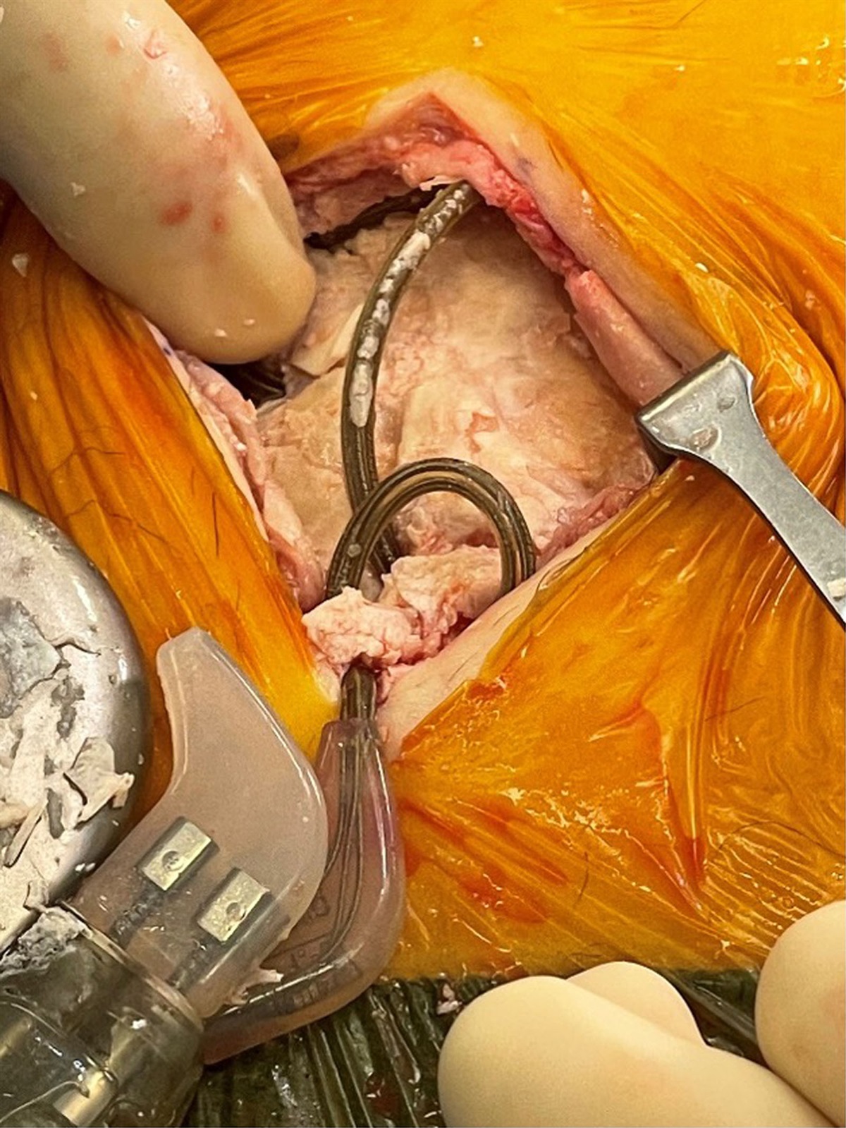 Severe Dystrophic Calcification of a Spinal Cord Stimulator Pulse Generator Pocket: A Case Report