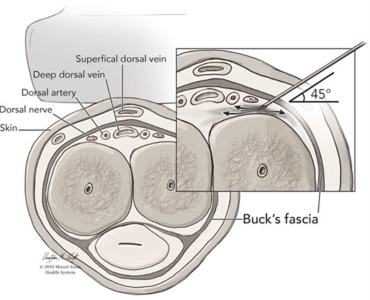 A Case of Chronic Penile Pain Successfully Treated With Dorsal Nerve Block