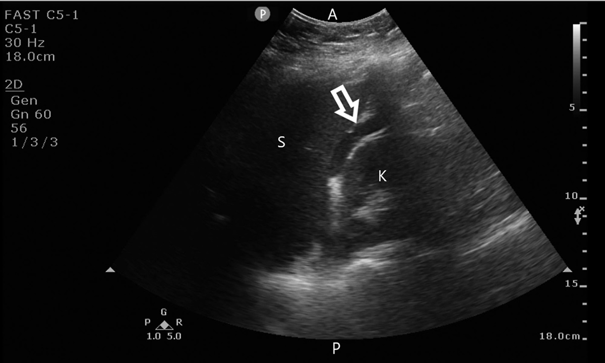 Ultrasound Rounds: Anesthesiologist-Performed Intraoperative Point-of-Care Focused Assessment With Sonography in Trauma Examination Changes Surgical Management
