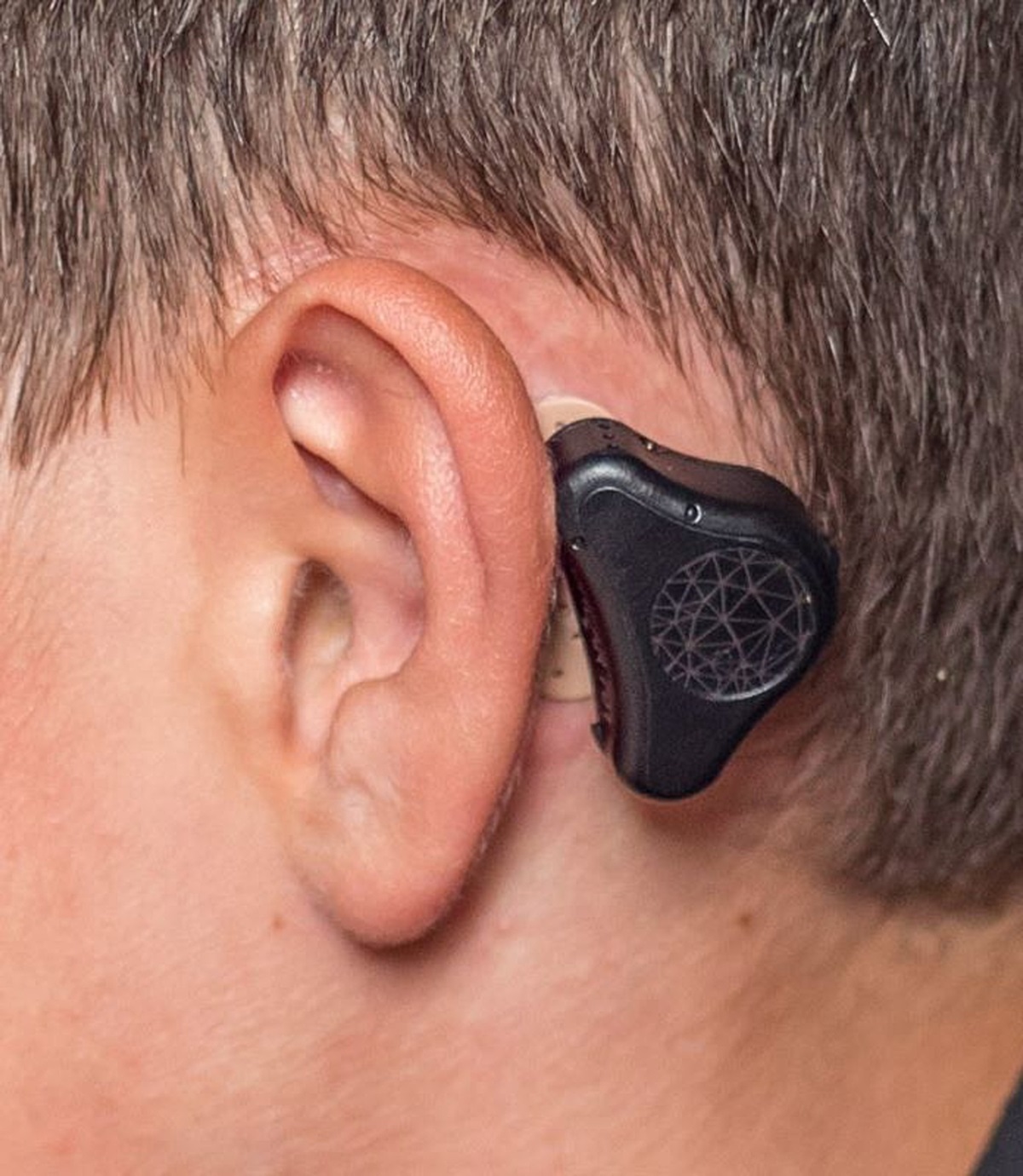 Results of a Novel, Nonsurgical Bone-Conduction Hearing Aid for the Treatment of Conductive Hearing Loss in Australian Children