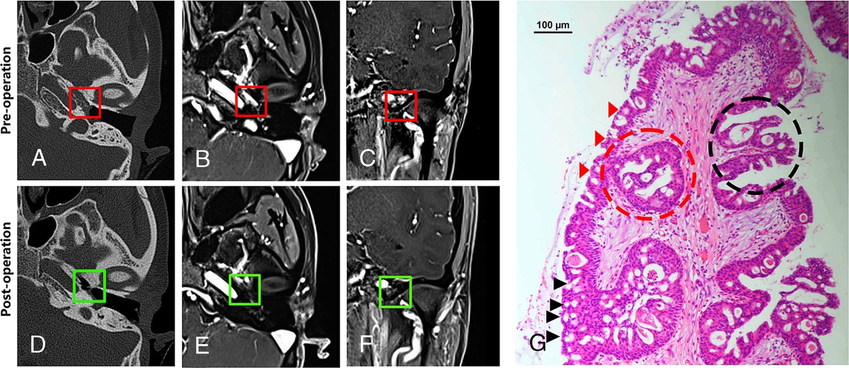 Key Genes and Endoscopic Radical Surgery in Primary Middle Ear Oncocytic Papillomas