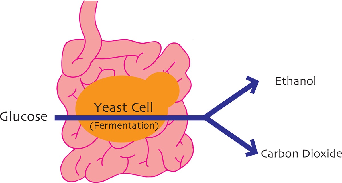 Auto-Brewery Syndrome and General Anesthesia: A Case Report