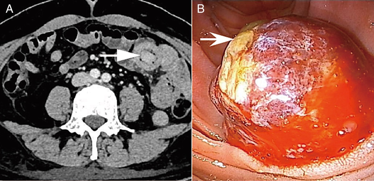 Small Bowel Metastases From Malignant Phyllodes Breast Tumor Detected by 18F-FDG PET/CT