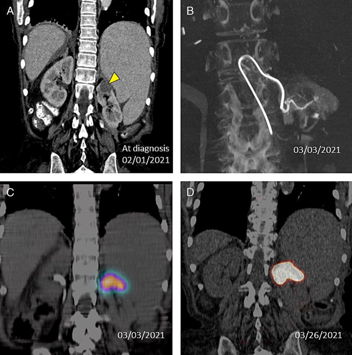 Partial Radiation Nephrectomy Using 90Y Resin Microspheres: A Treatment Option for Renal Tumors With Malignant Characteristics in Patients Not Candidates for Surgery