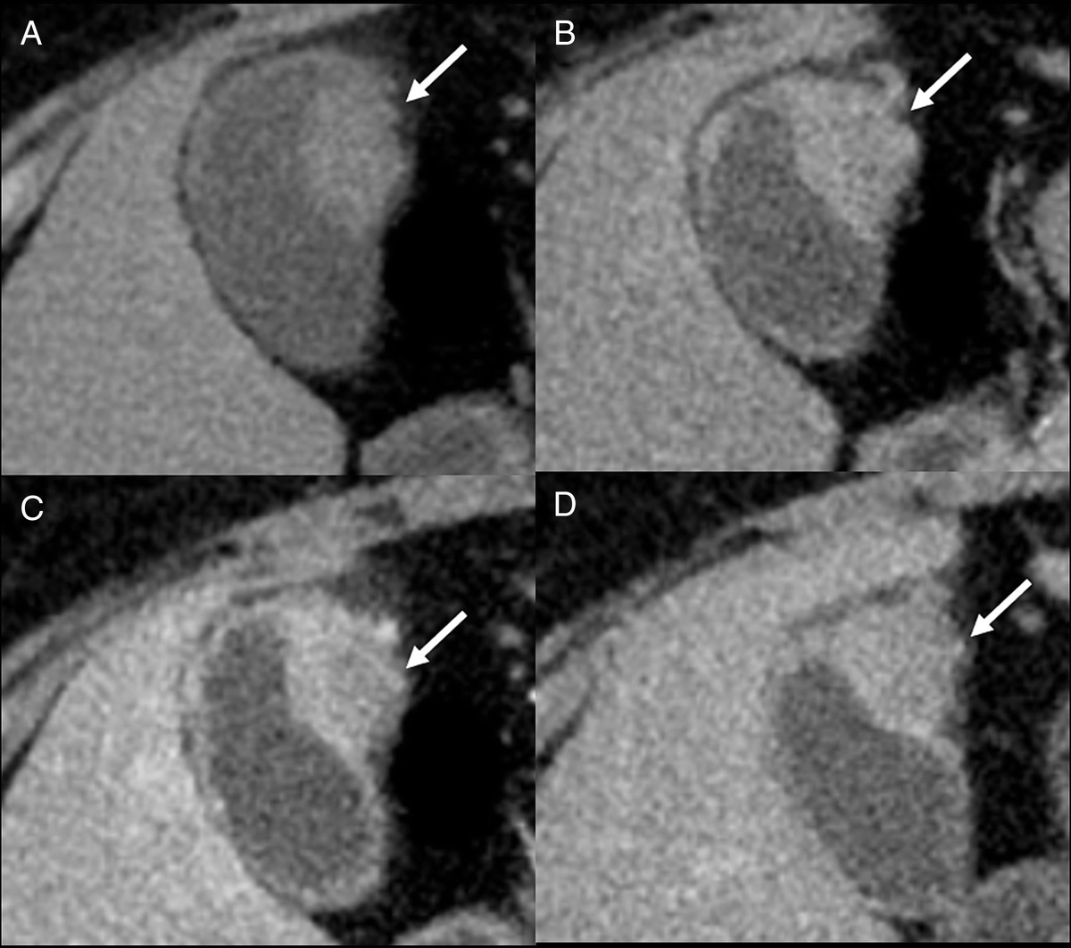Increased 68Ga-FAPI Activity in Primary Small Cell Neuroendocrine Carcinoma of the Gallbladder