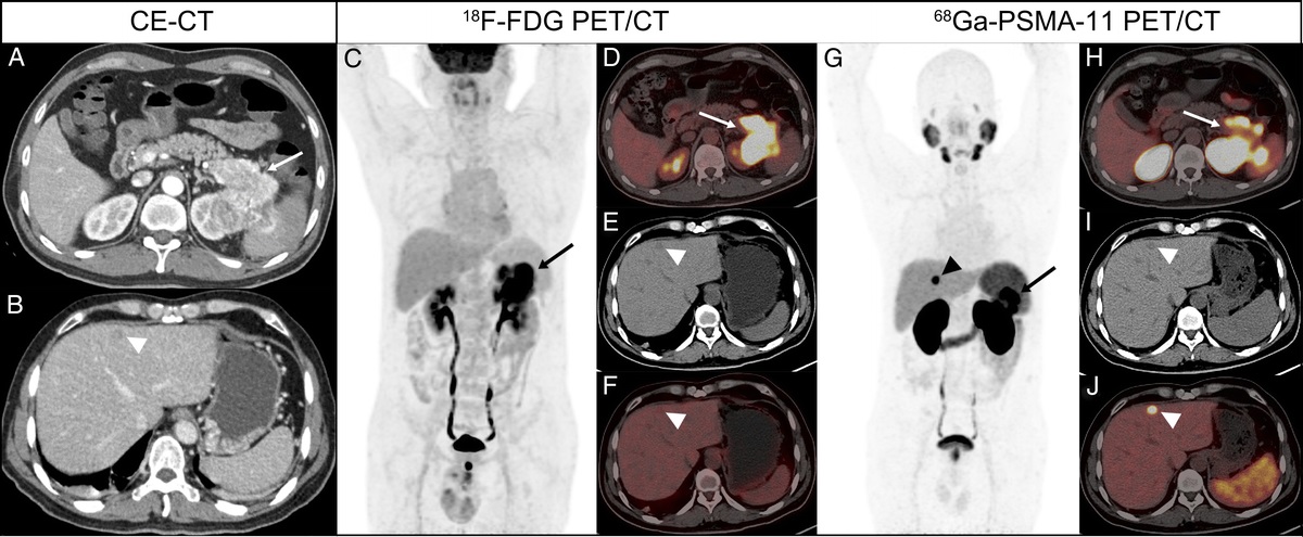 68Ga-PSMA PET/CT in Hepatic Metastasis From Pancreatic Neuroendocrine Tumor