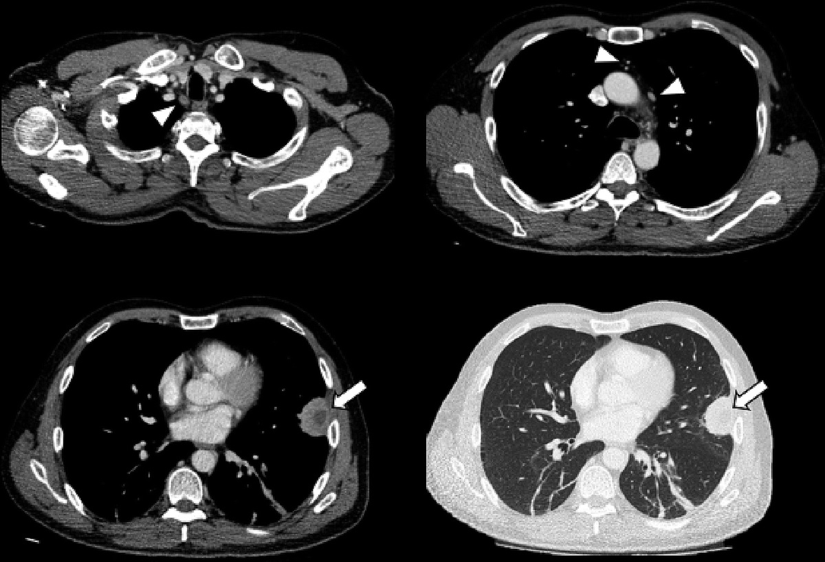 Syphilis Mimicking Malignant Pulmonary Tumor With Nodal and Bone Metastasis on 18F-FDG PET/CT