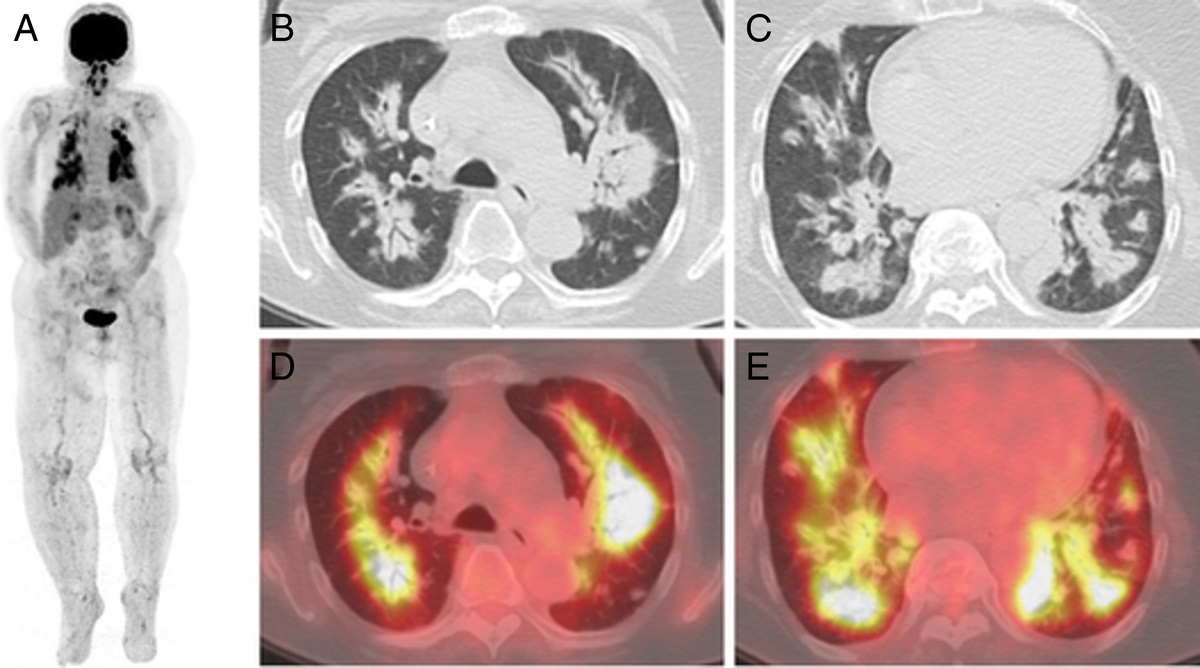 Pembrolizumab-Associated Pneumonitis Resembling Lymphangitic Carcinomatosis in a Melanoma Patient