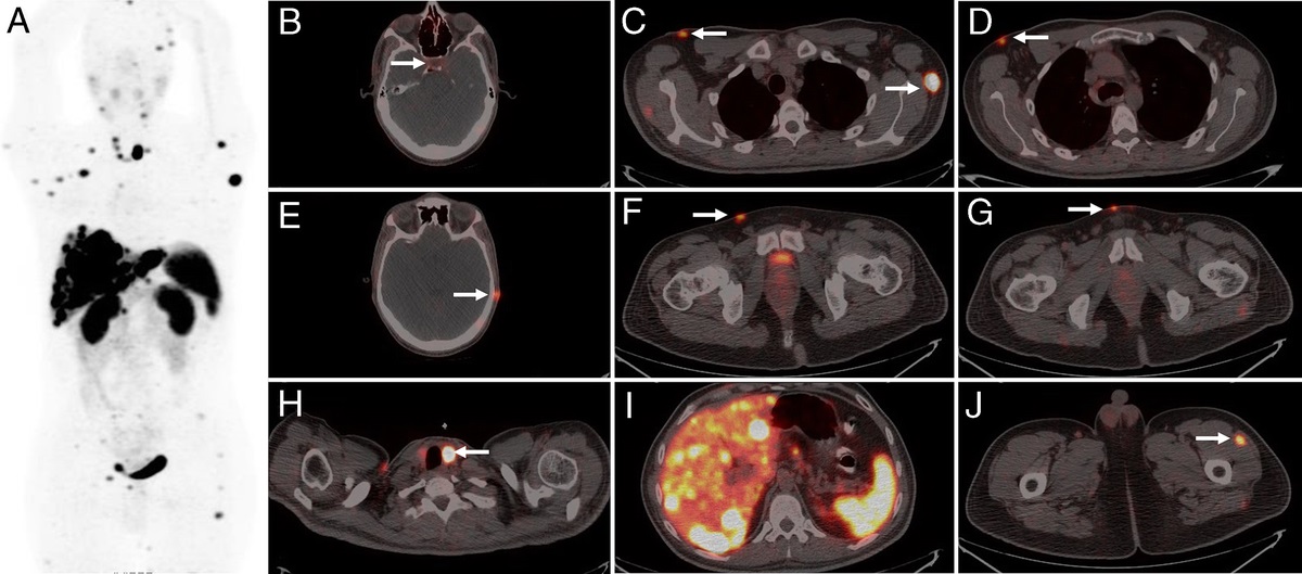 Skin and Subcutaneous Tissue Metastases of the Pulmonary Carcinoid Tumor on 68Ga-DOTATATE PET/CT