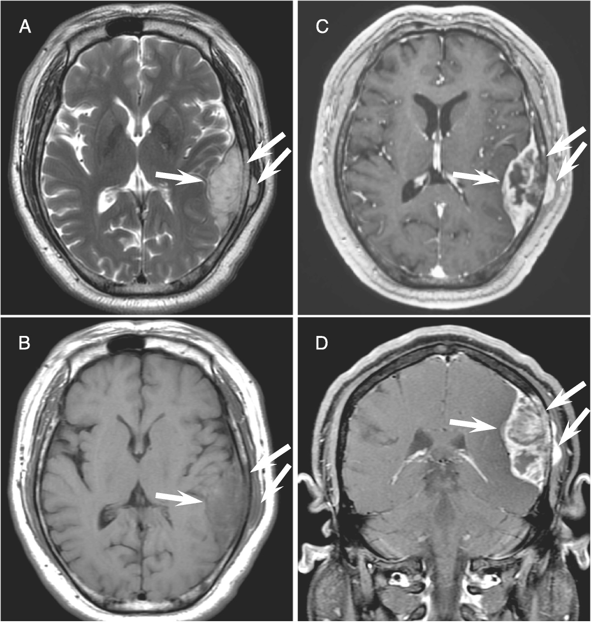 Isolated Skull Metastasis With Unusual Spiculated Periosteal Reaction From Rectal Cancer Resembling Osteosarcoma on FDG PET/CT