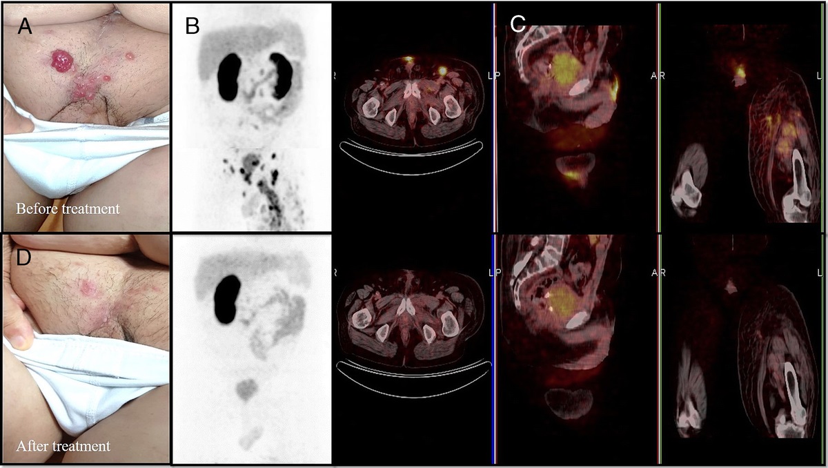 68Ga-PSMA PET/CT Images of Multiple Cutaneous Metastases in a Patient With Prostate Carcinoma: Complete Response to: 177: Lu-PSMA-617 Treatment