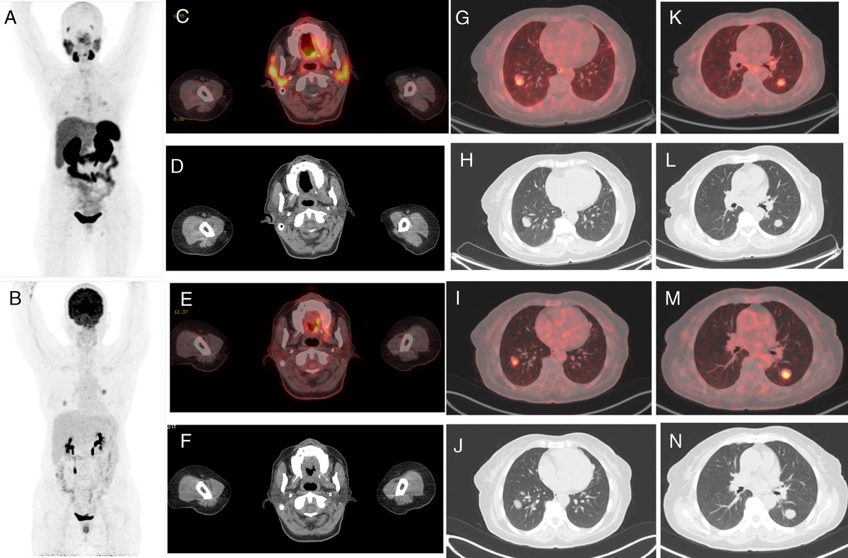 Comparison of 68Ga-PSMA-HBED-CC and 18F-FDG PET/CT in the Evaluation of Adenoid Cystic Carcinoma—A Prospective Study