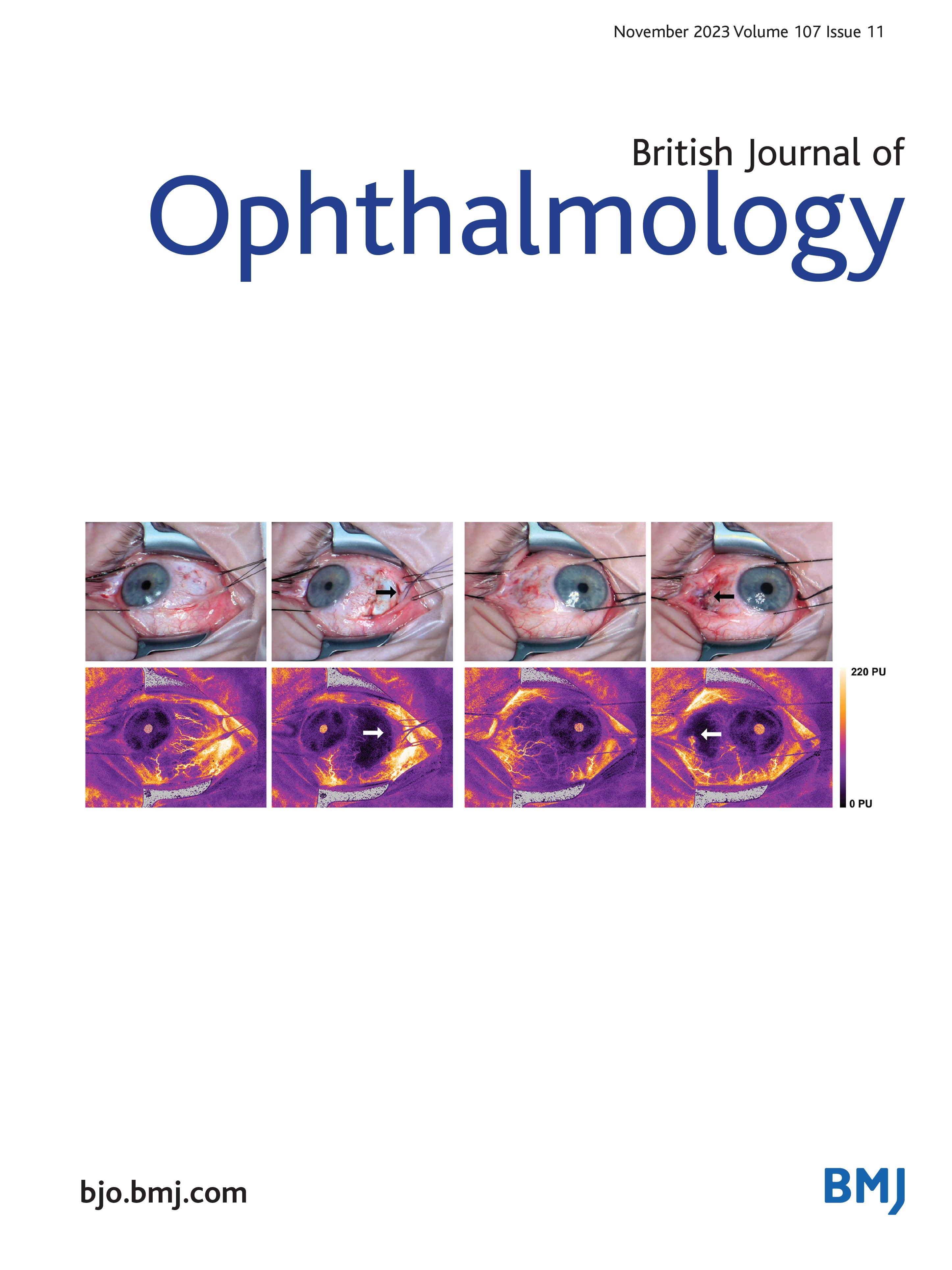 Persistent subfoveal fluid in pneumatic retinopexy versus pars plana vitrectomy for rhegmatogenous retinal detachment: posthoc analysis of the PIVOT randomised trial