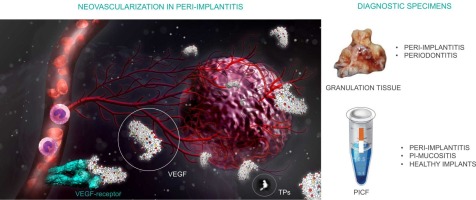 Diagnostic value of VEGF in peri-implantitis and its correlation with titanium particles: A controlled clinical study