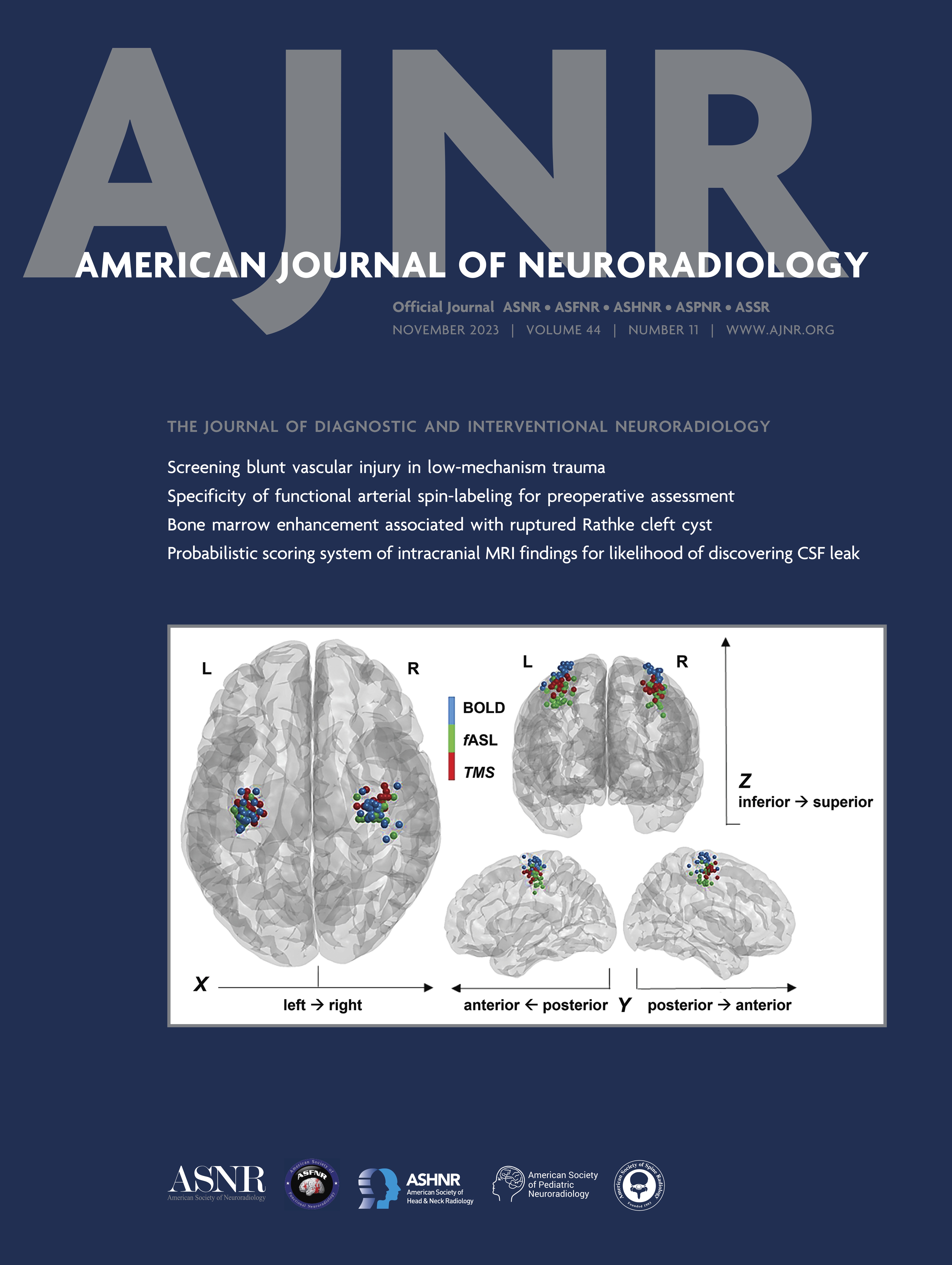 4D-DSA for Assessment of the Angioarchitecture and Grading of Cranial Dural AVF [NEUROINTERVENTION]