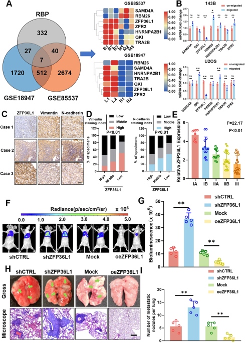 Low expression of ZFP36L1 in osteosarcoma promotes lung metastasis by inhibiting the SDC4-TGF-β signaling feedback loop